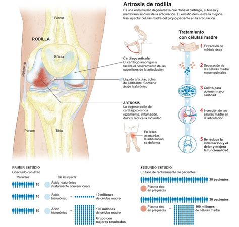 estómago Mirar fijamente Aflojar consecuencias de la artrosis de ...