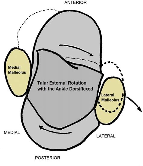 With the ankle in dorsiflexion, an external rotation force on the foot ...