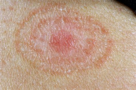 Ringworm (tinea) fungal skin infection - Stock Image - C011/7541 - Science Photo Library