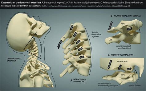 Atlantoaxial instability | 아나토미