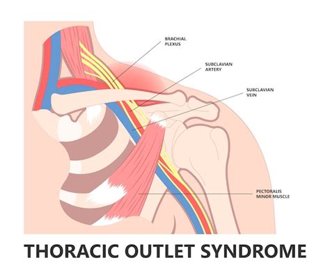 Thoracic Outlet Syndrome | The Surgical Clinic