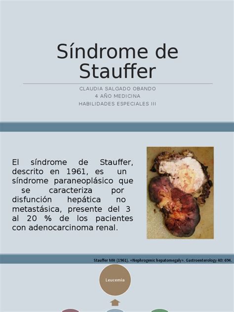 Síndrome de Stauffer | PDF