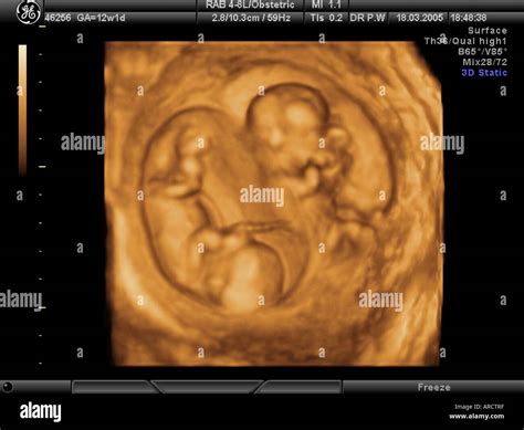 A 3D ultrasound scan of a twin pregnancy at 12 weeks gestation Stock Photo: 9151102 - Alamy