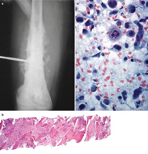 Methods of Bone Biopsy | Musculoskeletal Key