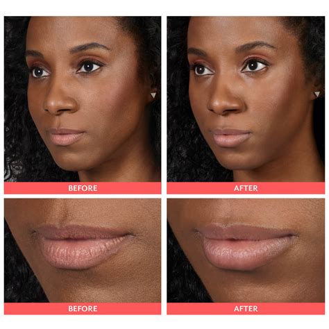 Lip Filler Before and After - Feel Ideal 360 Med Spa - Southlake, TX