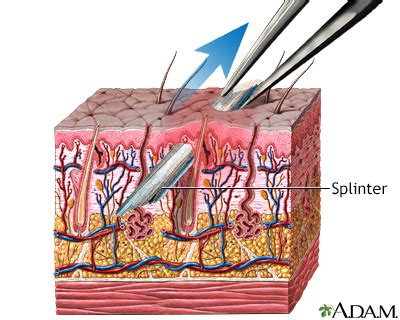 Splinter removal - UF Health