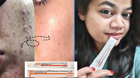 Clindac A Gel Before After Month Review Clindamycin Phosphate Gel USP Review How2 Treat Acne ...