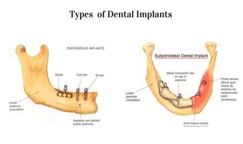 Dental Implants: Endosteal vs. Subperiosteal - Comparison