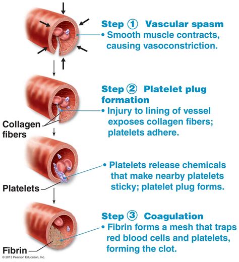 vascular spasm - Hello USA