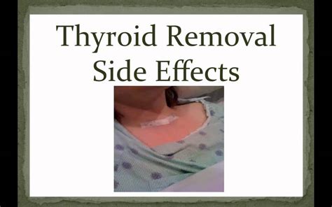 THYROID REMOVAL SIDE EFFECTS - YouTube