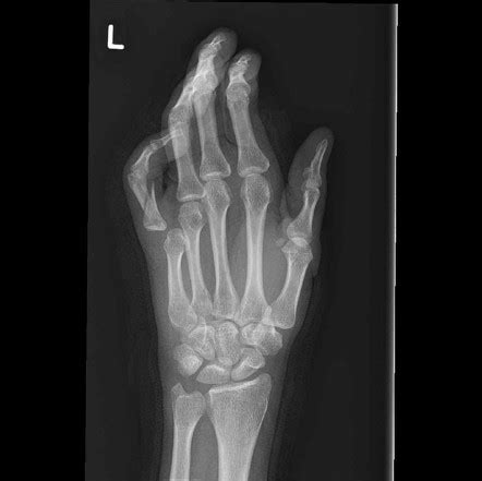 Metacarpophalangeal joint dislocation | Radiology Reference Article ...