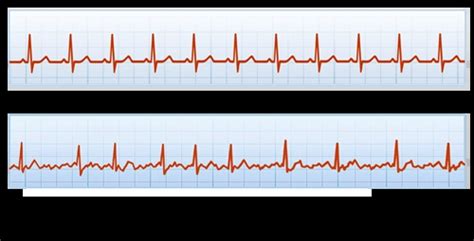 Video: EKG of Heart in Atrial Fibrillation on MonitorAtrial Fibrillation: Resources for Patients