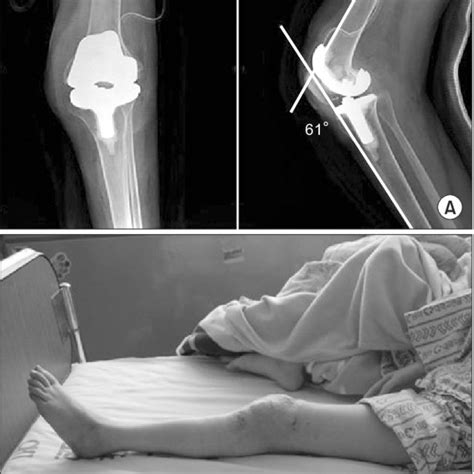 Flexion Contracture