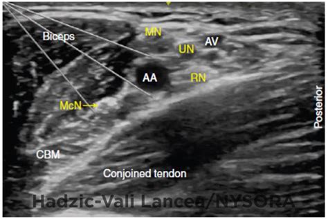 Ultrasound Guided Axillary Brachial Plexus Block Video Nysora | Images ...