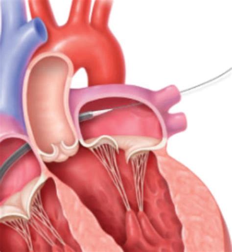 TMVr with MitraClip Procedure Is Minimally Invasive