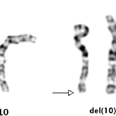 (PDF) Chromosome 10q Deletion del (10)(q26.1q26.3) is Associated with Cataract