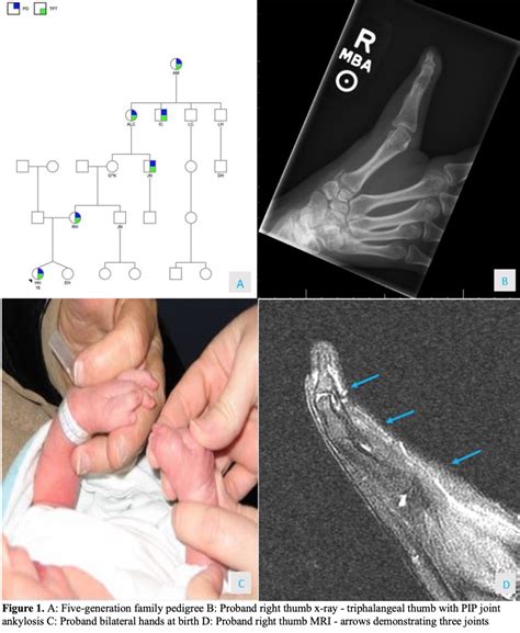 AAHS - Multigenerational Triphalangeal Thumb: Suspicion for a New Dominantly-Inherited Disorder ...