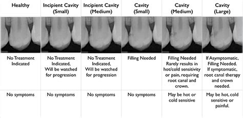 Fells Point Dental All About Cavities