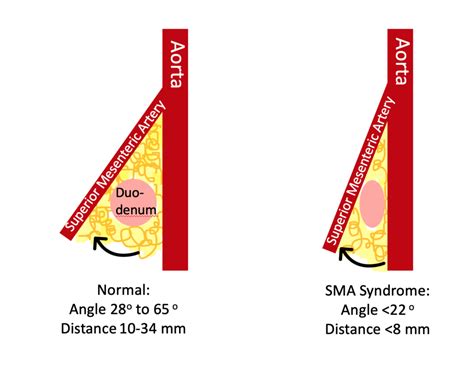 Superior Mesenteric Artery Syndrome (SMA Syndrome) in Children — Pediatric EM Morsels