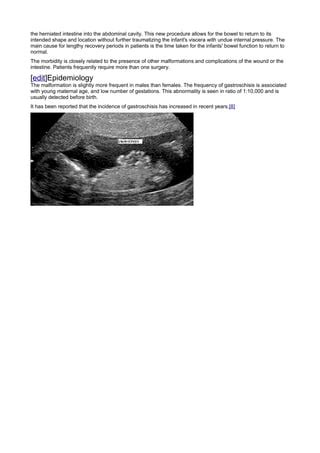 Gastroschisis | PDF