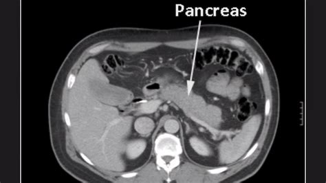 Normal Pancreas Size