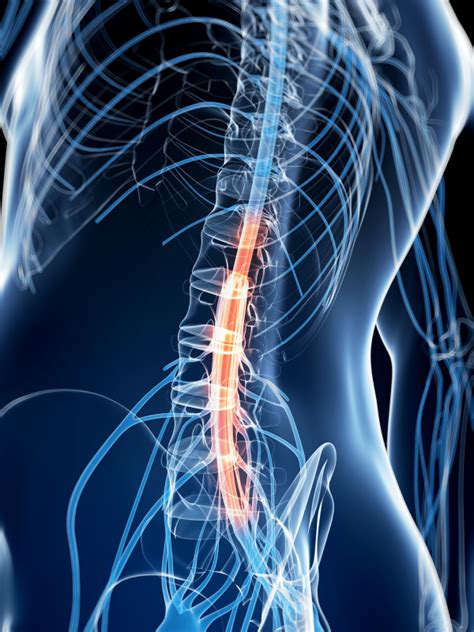 Spinal Stenosis - Michigan Spine & Pain