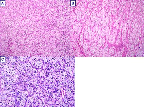 A, B and C: Microphotograph of histology of a patient with a recurrent... | Download Scientific ...