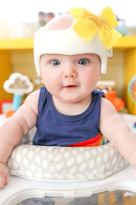 My Baby’s Plagiocephaly and Helmet Before and After