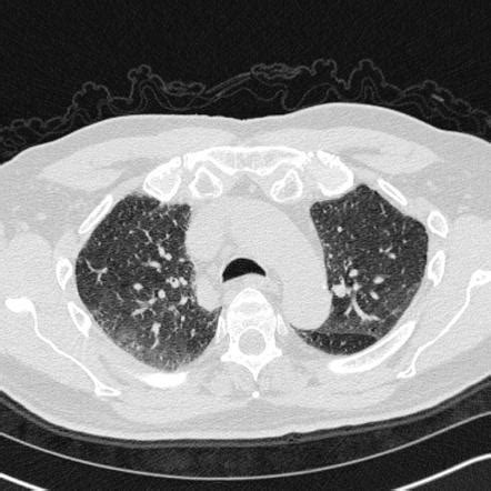 Tracheomalacia Newborn