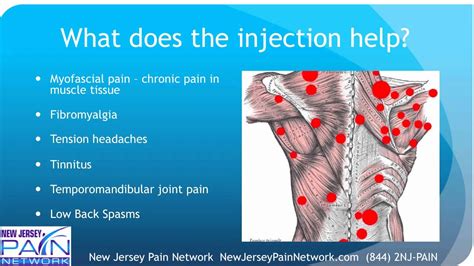 Cortisone Trigger Point Injections : Medical Exhibits, Demonstrative Aids, Illustrations and ...