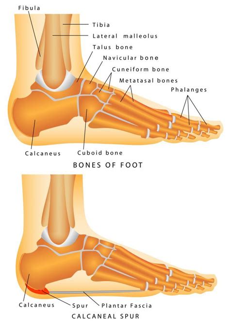 14 Ways How To Treat Plantar Fasciitis