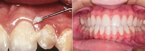 How to use one correctly, which model to buy, and how it compares to flossing. Waterpiks