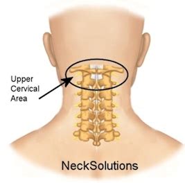 Rheumatoid Arthritis Neck