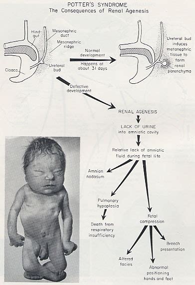 Doctors Gates: MNEMONIC for Features of Potter syndrome