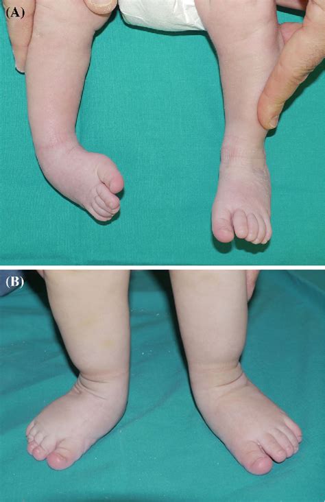 [PDF] Congenital idiopathic talipes equinovarus before and after ...