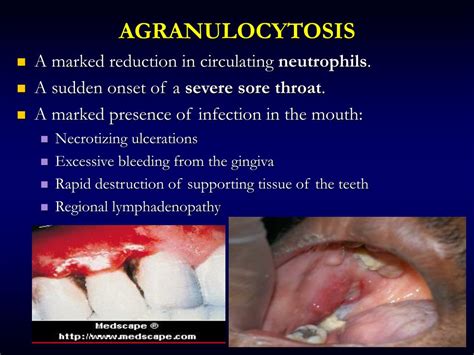 PPT - Oral Manifestations of Systemic Diseases PowerPoint Presentation - ID:5557459