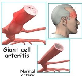 Giant Cell Arteritis Causes, Symptoms, Diagnosis and Treatment ...