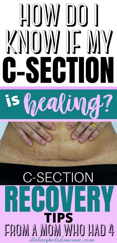 12 C-Section Recovery Tips To Heal Fast | C section recovery, C section, Healing from c section