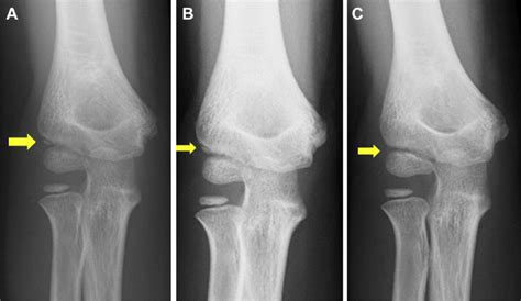 Bone healing developed gradually over time : A, 4 weeks; B, 8 weeks; C ...