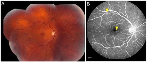 Retinal Vasculitis: Causes, Symptoms and Management | OBN