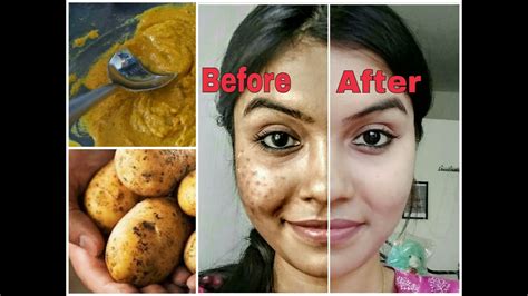 How To Remove Dark Spots On Face Home Remedies