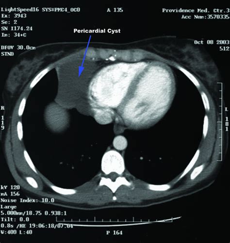 Pericardial Cyst | CTSNet