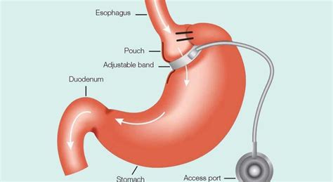 Gastric Banding Procedure and All about it | Healing Consulting Turkey