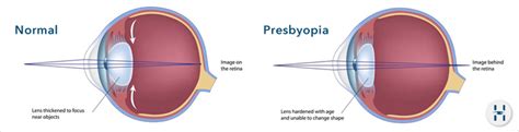 Presbyopia Problems - Do I need glasses or Longer arms?