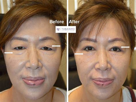 Before and After Asian Blepharoplasty Gallery | Taban MD