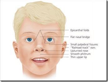 Fetal Alcohol Syndrome: Symptoms, Causes, Diagnosis, Treatment and More - Daily Chemist