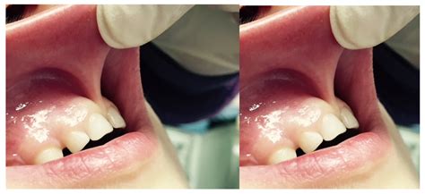 Labial Frenectomy Before And After