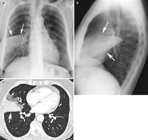 Fig. 7.1, [(a, b, c) Lobar pneumonia...]. - Diseases of the Chest ...