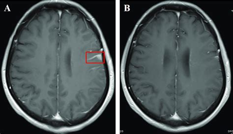 (A) Cranial enhanced MRI showing left frontotemporal linear enhancement... | Download Scientific ...