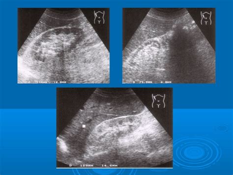 Abdominal ultrasound